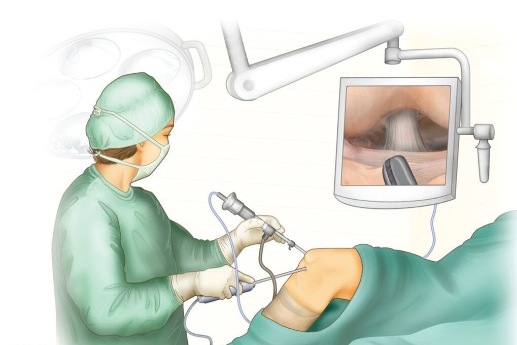 Chirurgie d'articulation du genou