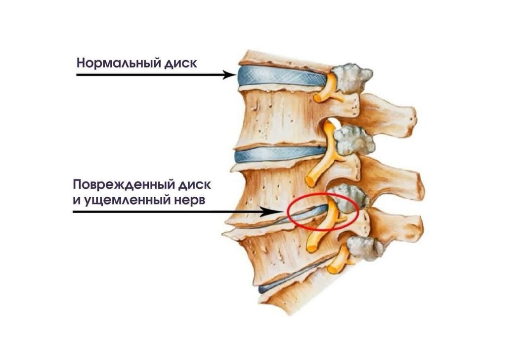Symptômes d'ostéochondose cervicale