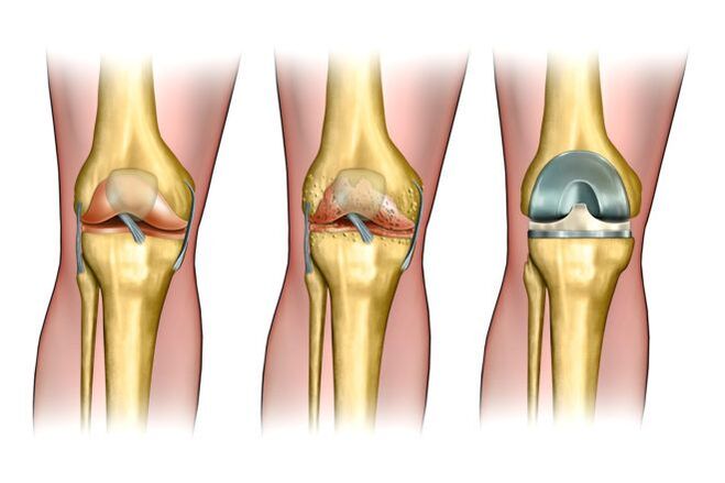 Degré d'arthrose