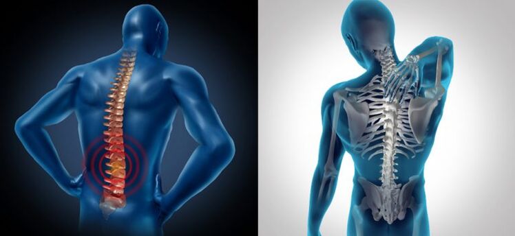 Inflammation dans l'ostéochondrose vertébrale.