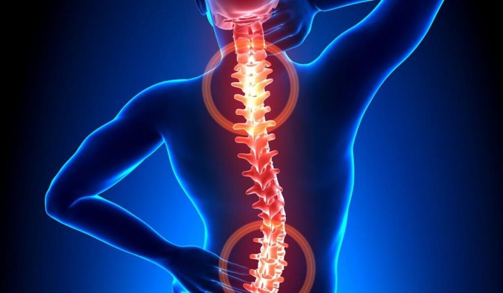 ostéochondrose de la colonne vertébrale